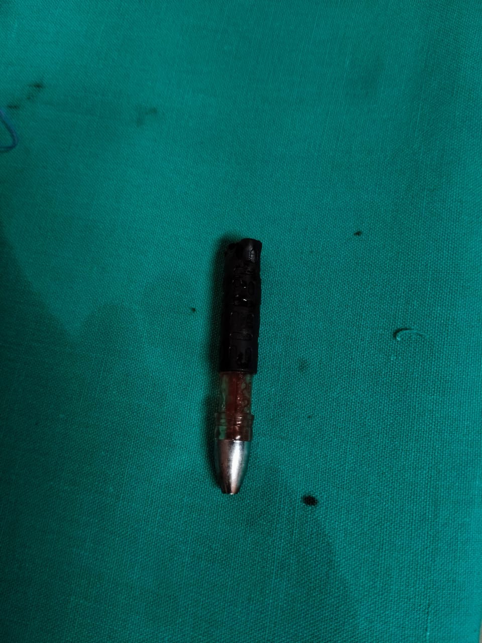 കൺപുരികത്തിനുള്ളിലേക്ക് തുളച്ചുകയറിയ പേനയുടെ ഭാഗങ്ങൾ ശസ്ത്രക്രിയയിലൂടെ വിജയകരമായി പുറത്തെടുത്തു; ചാലക്കുടി താലൂക്ക് ആശുപത്രിയിൽ അപൂർവ ചികിത്സാ വിജയം.